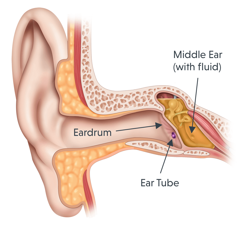 What Are Ear Tubes Tula